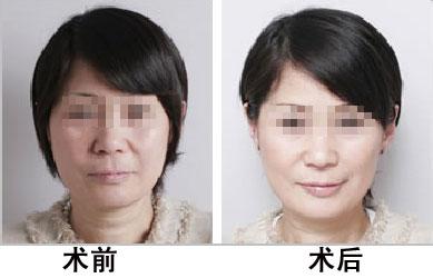 彩光<a href=http://www.sbs17.com/listinfo-770-0.html target=_blank class=infotextkey>嫩膚</a>手術(shù)有哪些禁忌？