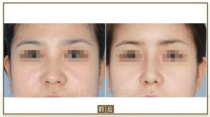 鼻子做完假體多久自然