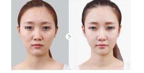 揭秘：彩光<a href=http://www.sbs17.com/listinfo-770-0.html target=_blank class=infotextkey>嫩膚</a>的副作用有多少