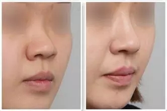 鼻子墊假體多久能化妝