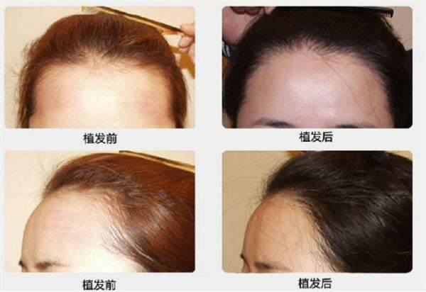 植發(fā)手術(shù)安全嗎