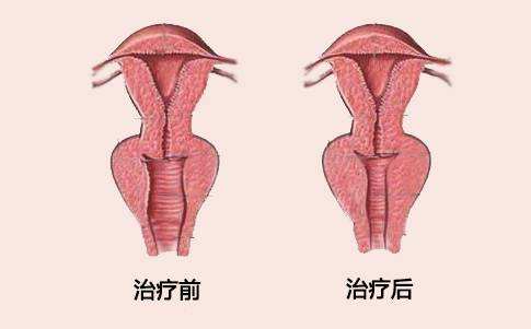 <a href=http://www.sbs17.com/listinfo-810-0.html target=_blank class=infotextkey>陰道緊縮</a>術(shù)有哪些適應(yīng)人群和禁忌癥