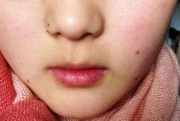 激光點(diǎn)痣后要注意什么