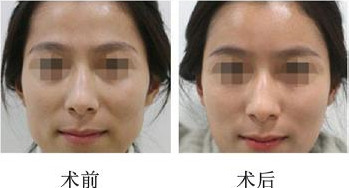 透明質(zhì)酸<a href=http://www.sbs17.com/listinfo-630-0.html target=_blank class=infotextkey>豐太陽穴</a>有后遺癥嗎