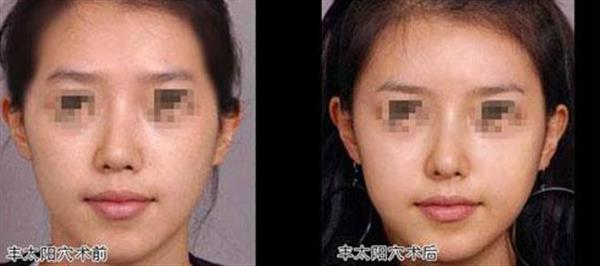 透明質(zhì)酸<a href=http://www.sbs17.com/listinfo-630-0.html target=_blank class=infotextkey>豐太陽(yáng)穴</a>一般能維持多久