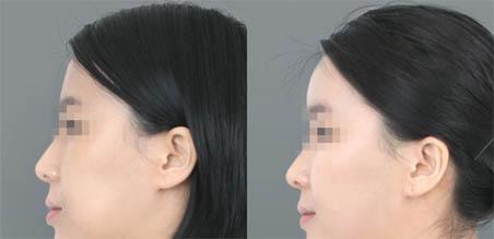 脂肪如何<a href=http://www.sbs17.com/listinfo-643-0.html target=_blank class=infotextkey>豐額頭</a>
