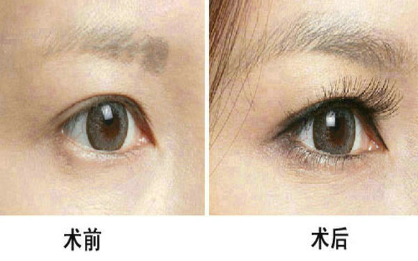 <a href=http://www.sbs17.com/listinfo-655-0.html target=_blank class=infotextkey>切眉</a>和提眉哪個(gè)效果好?