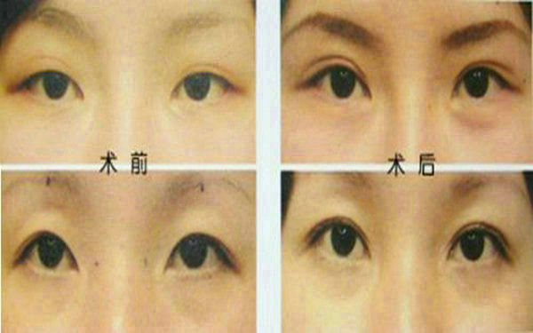 <a href=http://www.sbs17.com/listinfo-655-0.html target=_blank class=infotextkey>切眉</a>后多久可以<a href=http://www.sbs17.com/listinfo-657-0.html target=_blank class=infotextkey>繡眉</a>?