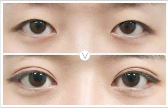 三點<a href=http://www.sbs17.com/listinfo-724-0.html target=_blank class=infotextkey>雙眼皮</a>是長期的嗎