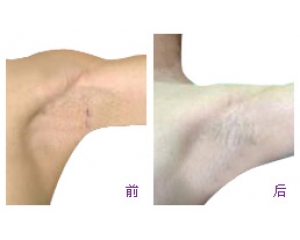 怎么才能治療狐臭