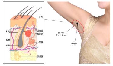 有什么方法<a href=http://www.sbs17.com/listinfo-766-0.html target=_blank class=infotextkey>去腋臭</a>
