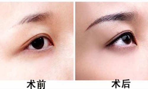 提眉術(shù)多少錢？