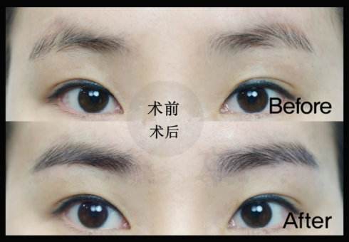 <a href=http://www.sbs17.com/listinfo-657-0.html target=_blank class=infotextkey>繡眉</a>后1至7天的變化圖