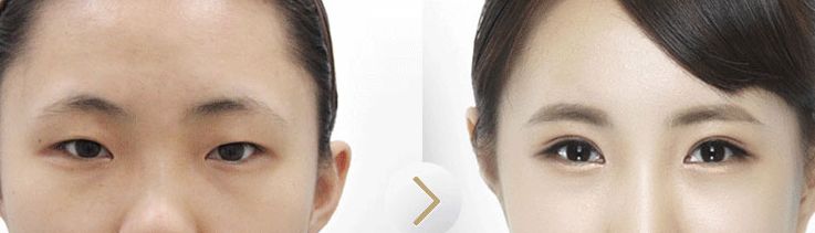 韓式長期<a href=http://www.sbs17.com/listinfo-724-0.html target=_blank class=infotextkey>雙眼皮</a>價(jià)格