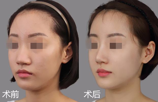 杭州天津做自體軟骨<a href=http://www.sbs17.com/listinfo-737-0.html target=_blank class=infotextkey>隆鼻</a>要多少錢