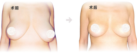 深圳胸下垂手術(shù)疤痕圖片