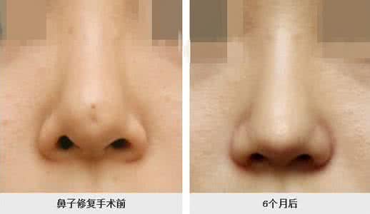 硅膠<a href=http://www.sbs17.com/listinfo-737-0.html target=_blank class=infotextkey>隆鼻</a>排異圖片