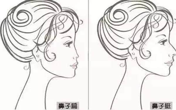 駱駝鼻手術(shù)方法