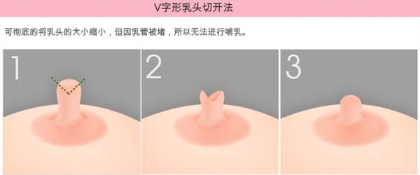 什么是乳頭<a href=http://www.sbs17.com/listinfo-625-0.html target=_blank class=infotextkey>乳暈縮小</a>術(shù)