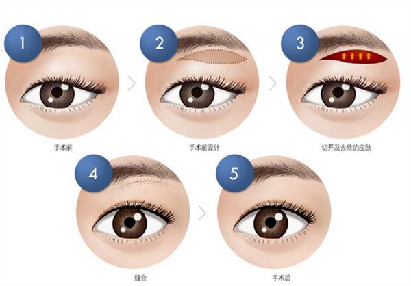 <a href=http://www.sbs17.com/listinfo-655-0.html target=_blank class=infotextkey>切眉</a>會(huì)留下疤痕嗎