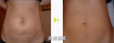 妊娠紋能徹底消除嗎