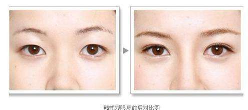 怎么變成<a href=http://www.sbs17.com/listinfo-724-0.html target=_blank class=infotextkey>雙眼皮</a>