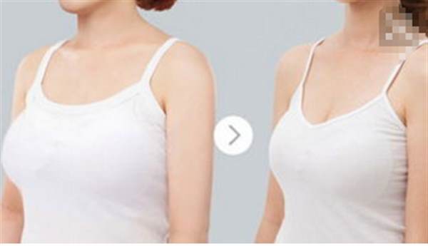 乳房縮小術(shù)價格