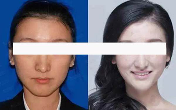 20歲發(fā)際線后移怎么辦
