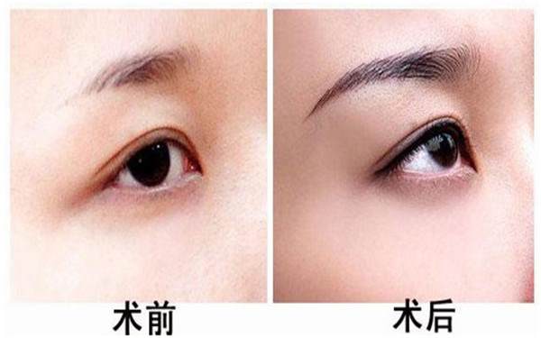 種植眉毛的適應人群及禁忌癥