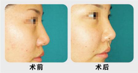 人中加深術(shù)后需注意哪些問題