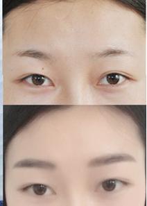 杭州韓式提眉術的手術步驟有哪些