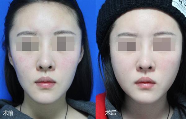 光子<a href=http://www.sbs17.com/listinfo-770-0.html target=_blank class=infotextkey>嫩膚</a>會給肌膚帶來什么樣的效果