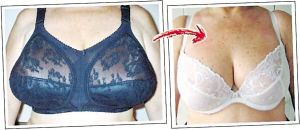 乳房縮小的手術(shù)過程詳解