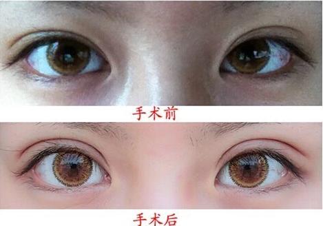 7.5平扇形<a href=http://www.sbs17.com/listinfo-724-0.html target=_blank class=infotextkey>雙眼皮</a>效果圖