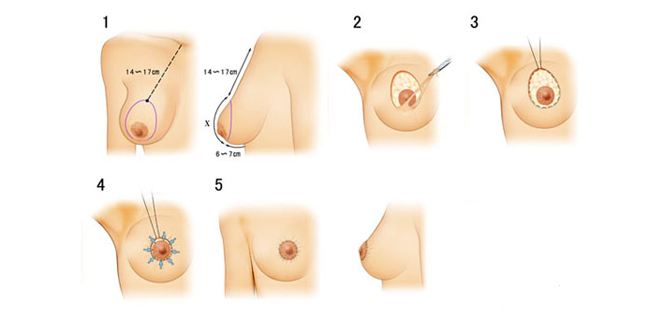 兩側(cè)乳房不對稱是怎么回事
