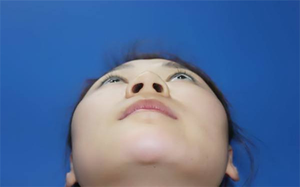 膨體<a href=http://www.sbs17.com/listinfo-737-0.html target=_blank class=infotextkey>隆鼻</a>術(shù)前術(shù)后的注意事項