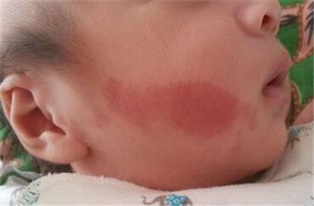 E激光治療鮮紅斑痣需要多少錢