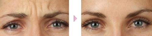 打botox<a href=http://www.sbs17.com/listinfo-614-0.html target=_blank class=infotextkey>除皺</a>瘦型素<a href=http://www.sbs17.com/listinfo-614-0.html target=_blank class=infotextkey>除皺</a>瘦型素去川字紋要多少錢