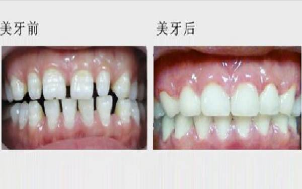 <a href=http://www.sbs17.com/listinfo-830-0.html target=_blank class=infotextkey>美容冠</a>前后對比