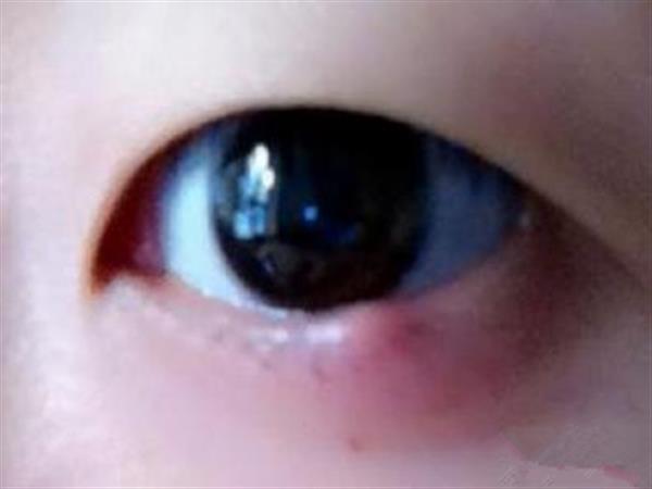 眼睛<a href=http://www.sbs17.com/listinfo-722-0.html target=_blank class=infotextkey>臥蠶</a>腫了怎么辦
