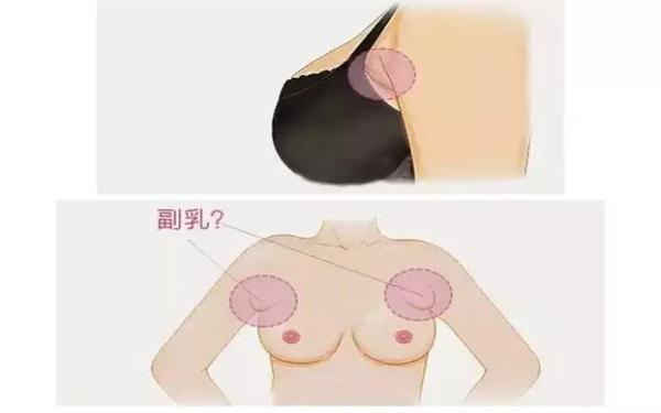 副乳切除手術(shù)多久恢復(fù)