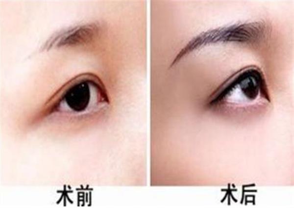 做眉毛整形手術(shù)一般多少錢