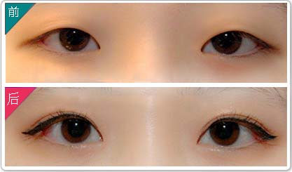 成都三點<a href=http://www.sbs17.com/listinfo-724-0.html target=_blank class=infotextkey>雙眼皮</a>價格是多少