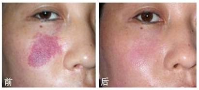 激光治療蜘蛛痣優(yōu)點(diǎn)有哪些