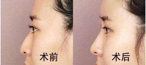 注射<a href=http://www.sbs17.com/listinfo-737-0.html target=_blank class=infotextkey>隆鼻</a>術(shù)價(jià)格