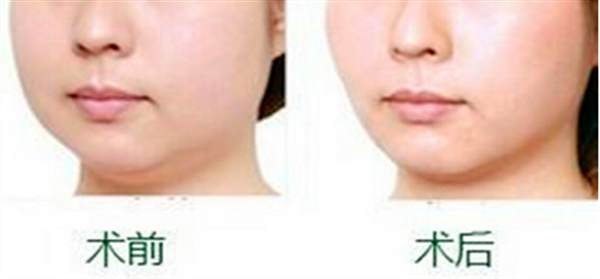 面部填充脂肪多久恢復(fù)