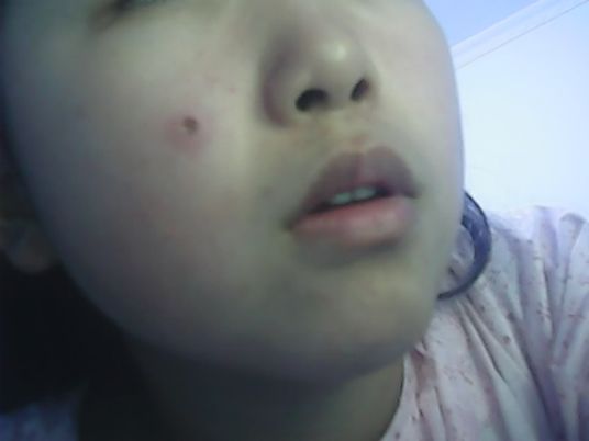 手術(shù)<a href=http://www.sbs17.com/listinfo-767-0.html target=_blank class=infotextkey>祛痣</a>前應(yīng)該注意什么呢