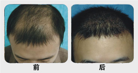額頭種植毛發(fā)多少錢