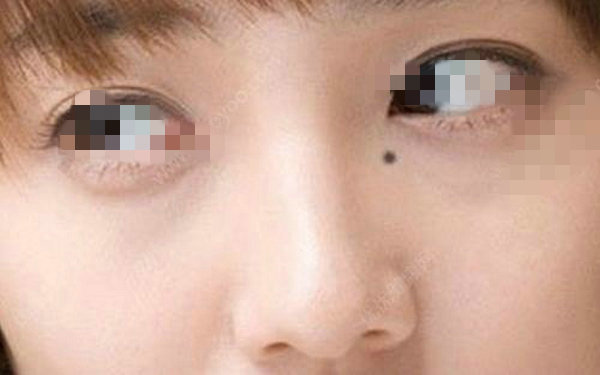 去痣后會(huì)留疤痕嗎？