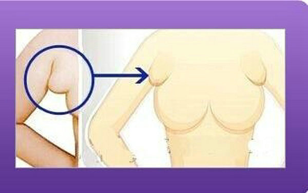 詳解副乳切除手術(shù)過程